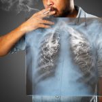 tumore-polmone-fumatori